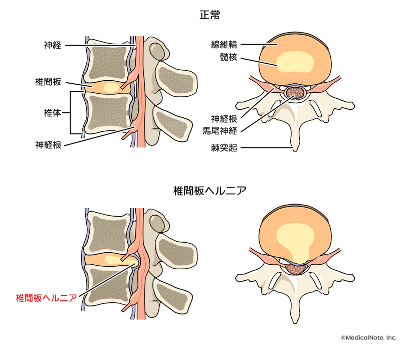 椎間板ヘルニアの構造