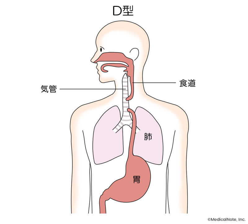 D型食道閉鎖症
