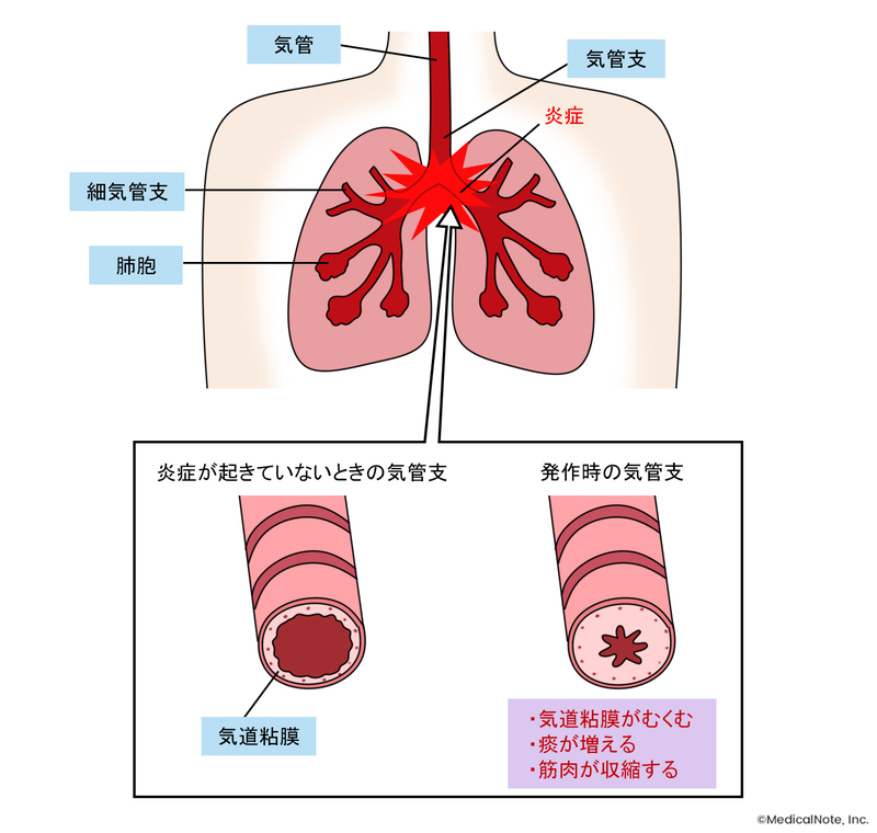喘息の人の気管支