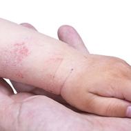 災害時のアトピー性皮膚炎の子どもへの公共的な配慮―災害時における子供へのアレルギー疾患対応 その4