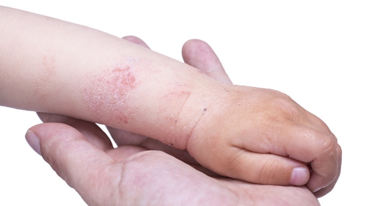 災害時のアトピー性皮膚炎の子どもへの公共的な配慮―災害時における子供へのアレルギー疾患対応 その4