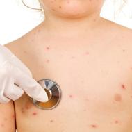 薬疹の症状と検査ー発疹の種類とその特徴は？