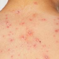 薬疹の症状 ３種類の重症薬疹とは？