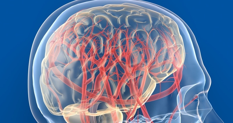 急性主幹動脈閉塞症とは。太い血管が詰まり脳梗塞に至る