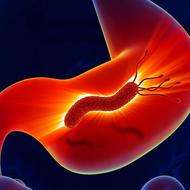 胃潰瘍の原因とは？ ピロリ菌感染とNSAIDs服薬