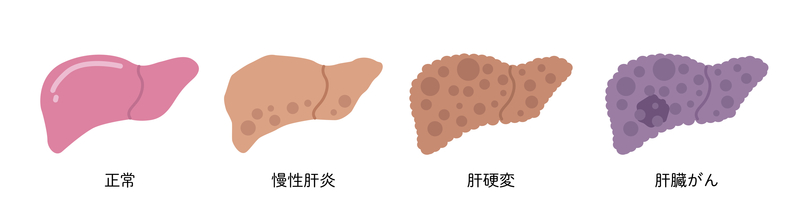 正常な肝臓と肝硬変の肝臓