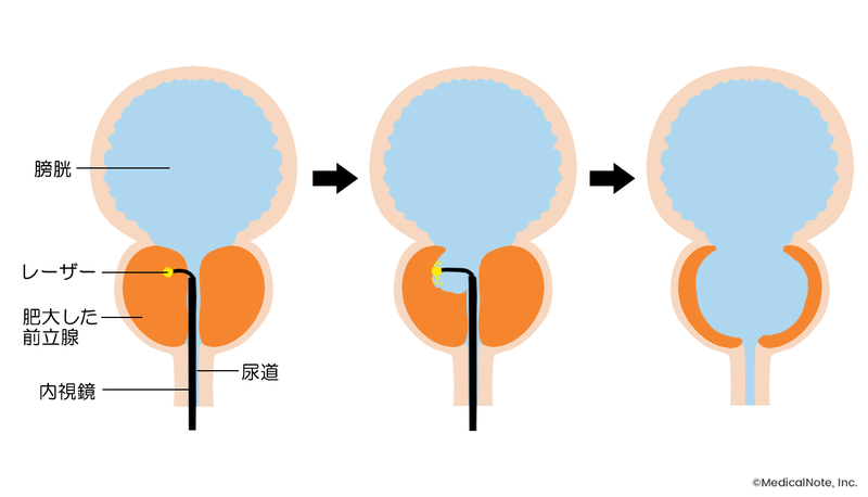 根治的前立腺切除術の種類