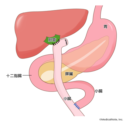 先天性胆道拡張症に対する腹腔鏡下手術の特徴と術後の注意点 メディカルノート