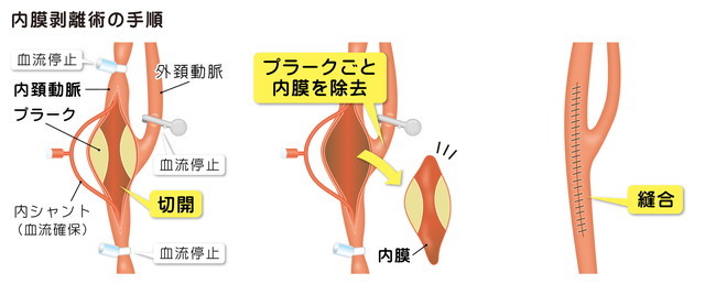 頸部頸動脈狭窄症の治療①頸動脈血栓内膜剥離術（CEA） | メディカルノート