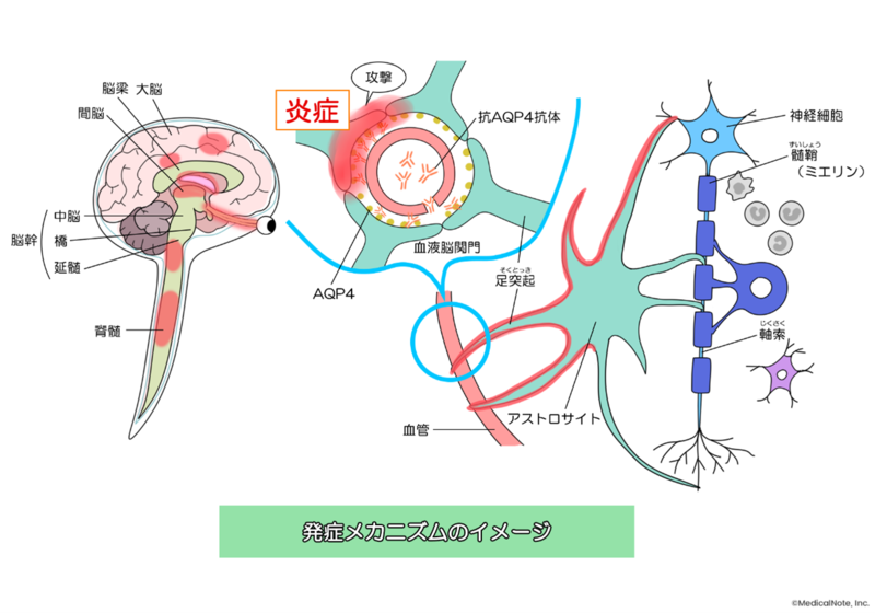 視神経炎の診断