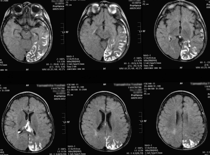 スタージ・ウェーバー症候群の症状は何ですか?