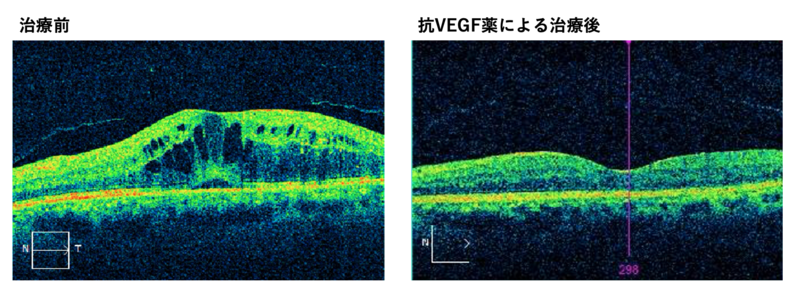 OCT検査による網膜の画像（ご提供画像）