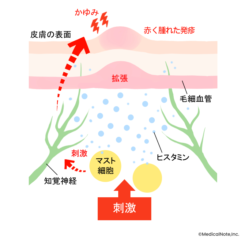 MN作成_蕁麻疹発症の様子