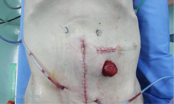 創部（開腹と人工肛門）