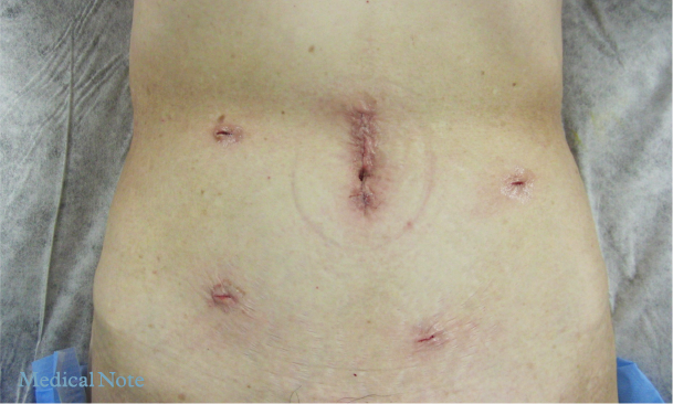 創部（腹腔鏡）