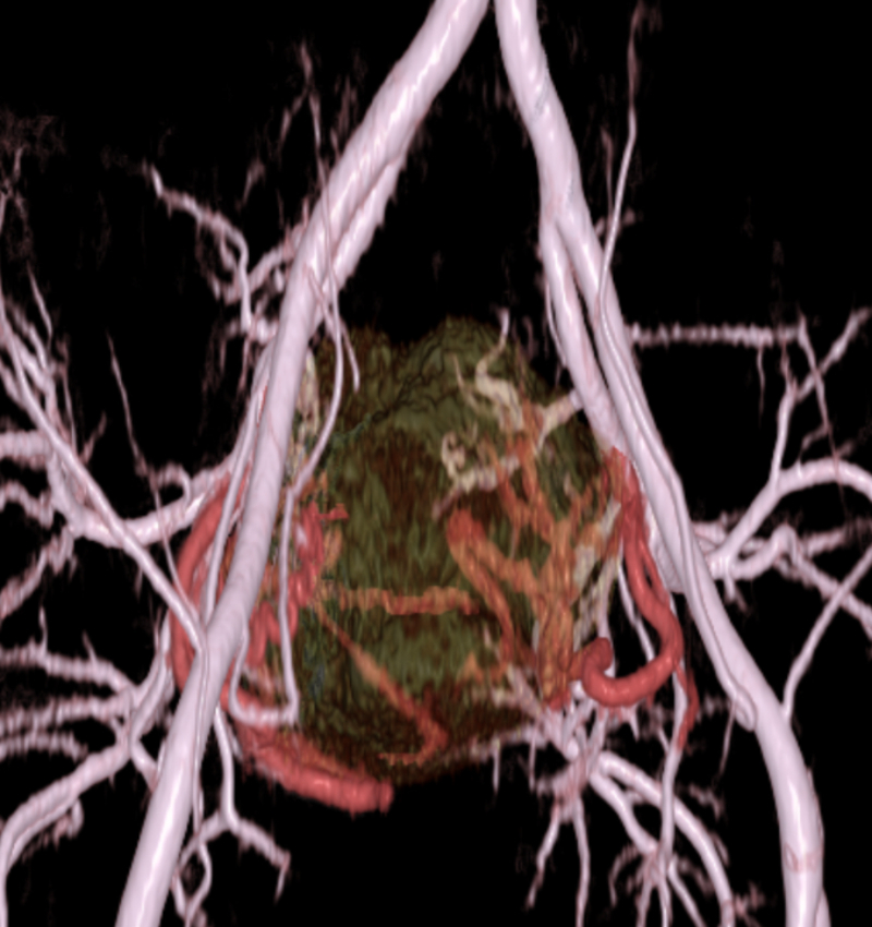 骨盤内3次元立体画像（赤い部分が子宮筋腫を栄養する動脈）