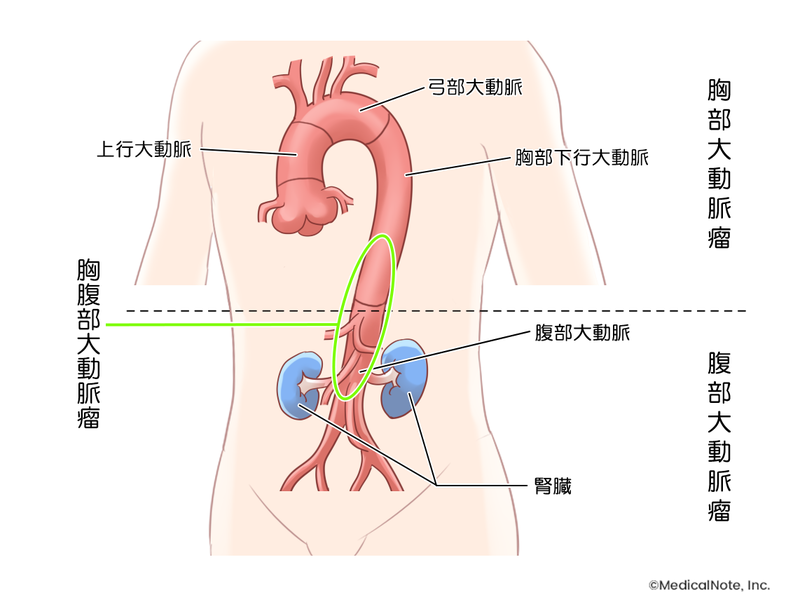 大動脈瘤とは