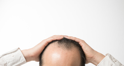 男性型脱毛症（AGA）とは？―男性ホルモンが影響する病気。「頭皮や髪の様子がおかしい」と感じたら早めの対策を
