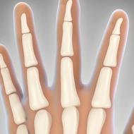 指の変形関節症