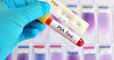 前立腺がんに対するPSA検査ー男性にとって必要になる場合、必要ではない場合