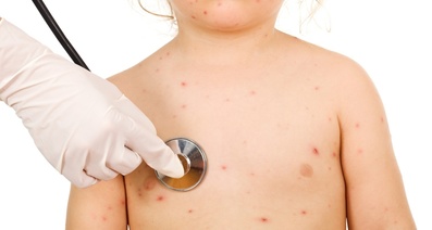 薬疹の症状と検査ー発疹の種類とその特徴は？