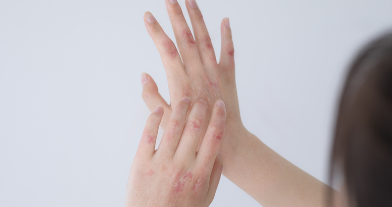 皮膚剥離による精神的影響への対処