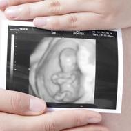 赤ちゃんを出産するときの注意－計画早産が好ましくない理由