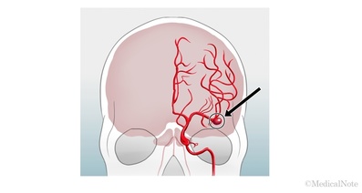 脳動脈瘤クリッピング術―症例パターン1　大型―巨大動脈瘤