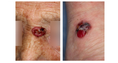 皮膚悪性腫瘍の病態と最新治療