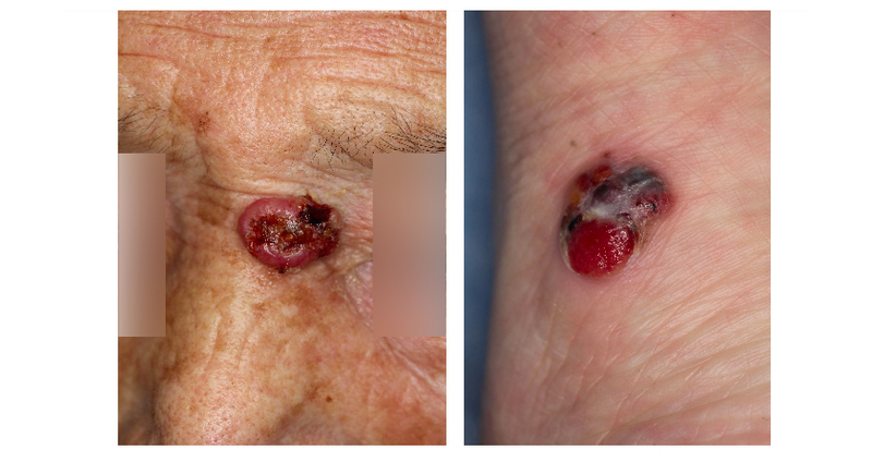 皮膚悪性腫瘍の病態と最新治療